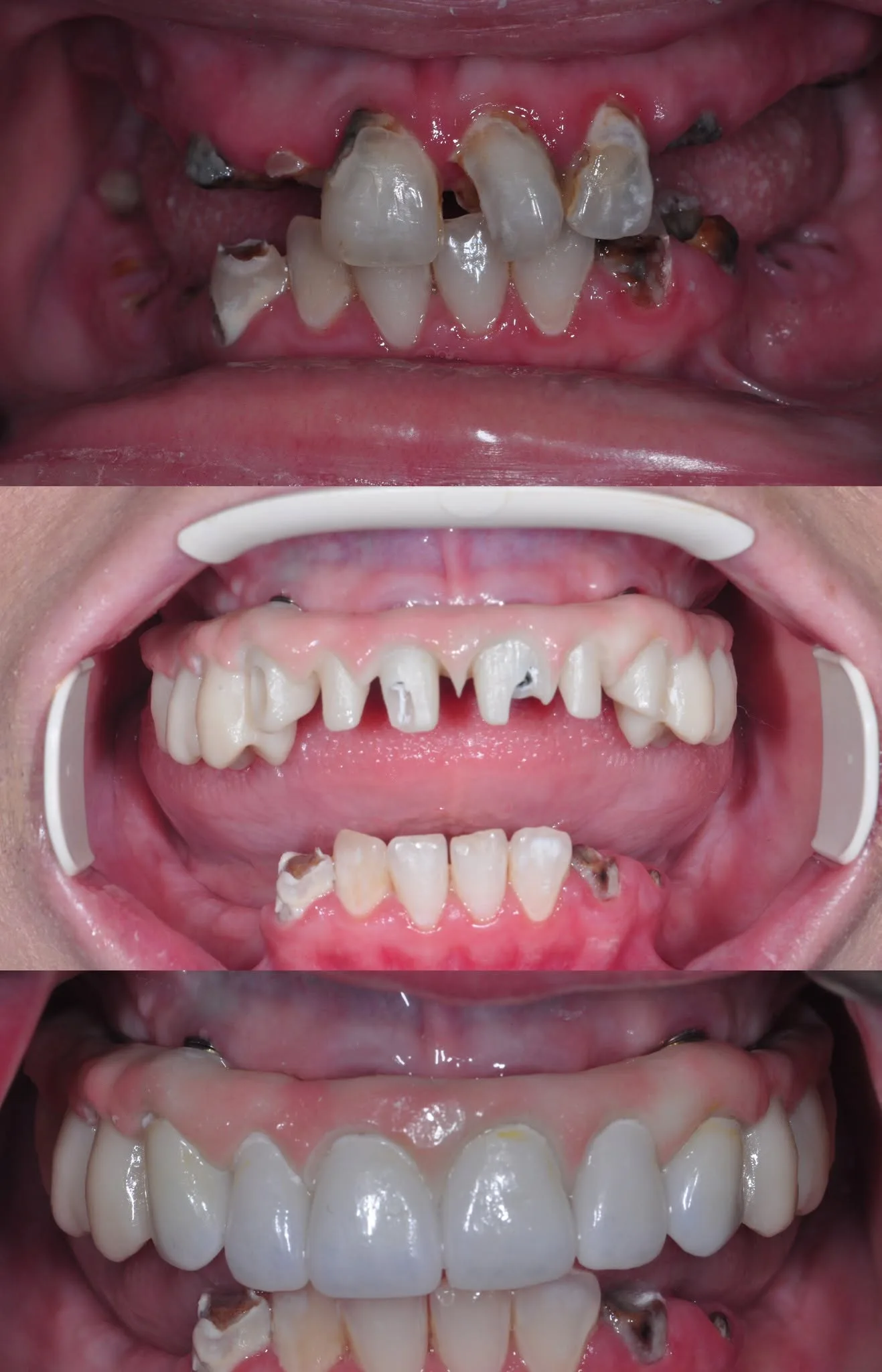 Before and after clinical photo: full-arch implant bridge