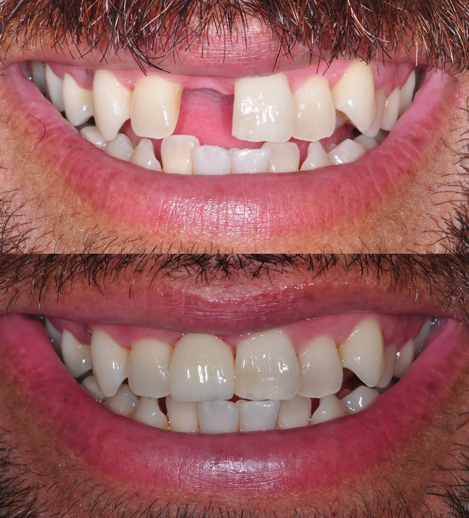 Before and after clinical photo: single front-tooth implant