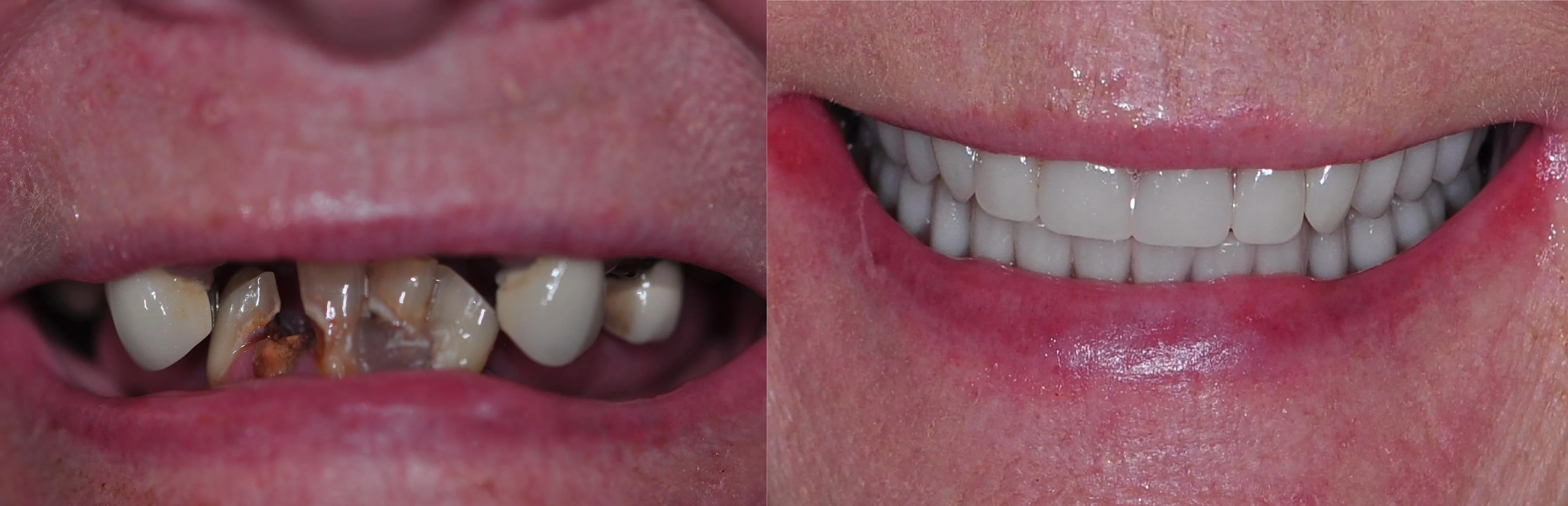 Before and after clinical photo: failing teeth to full-arch