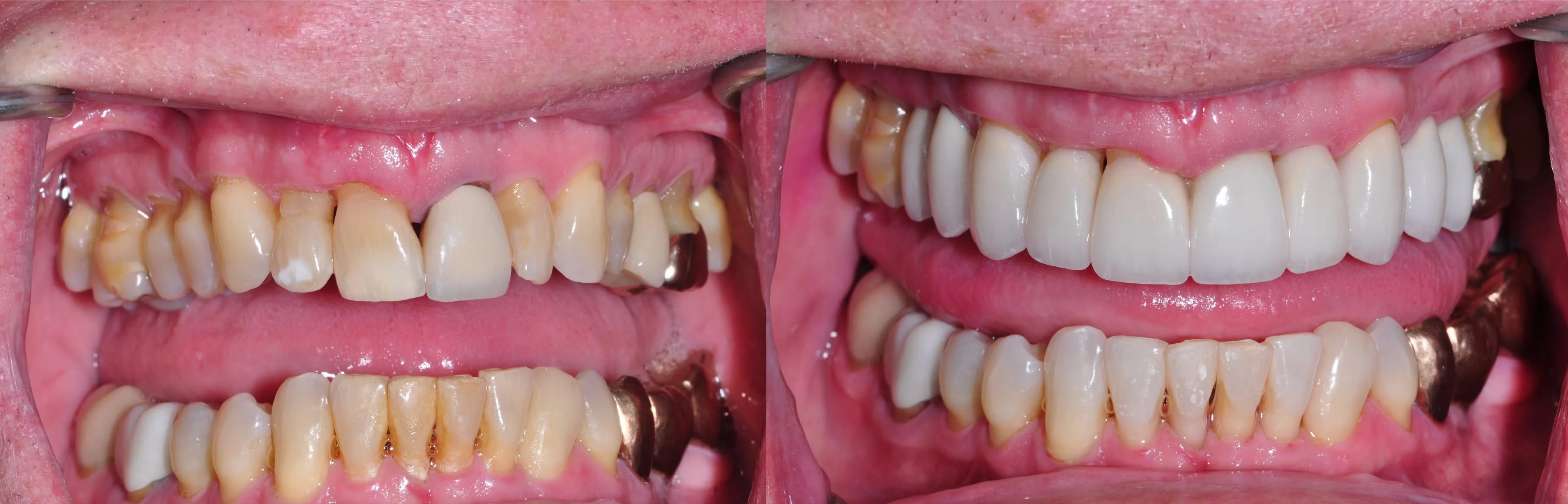 Before and after clinical photo: esthetic smile makeover