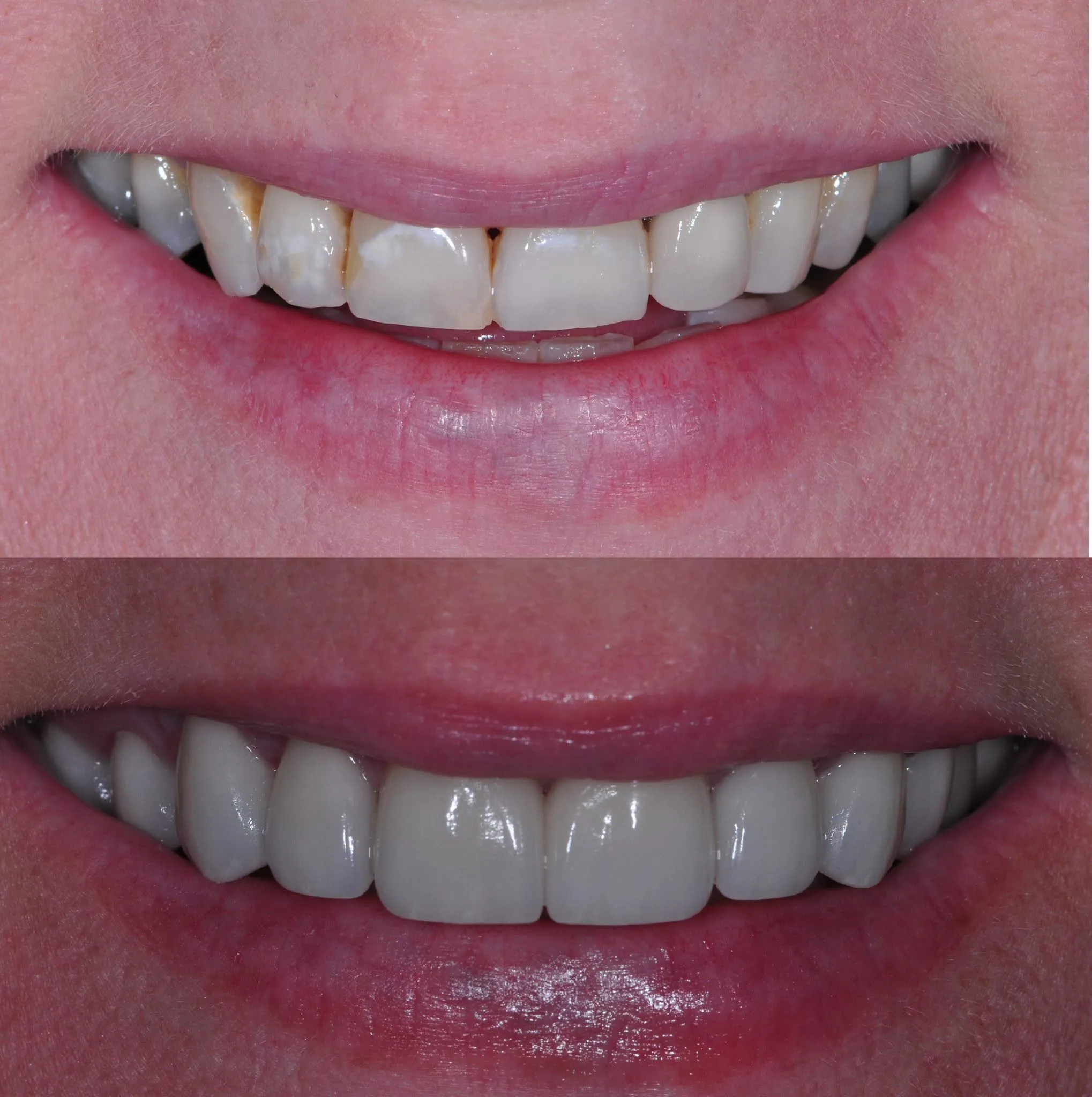 Before and after clinical photo: smile brightening and reshape