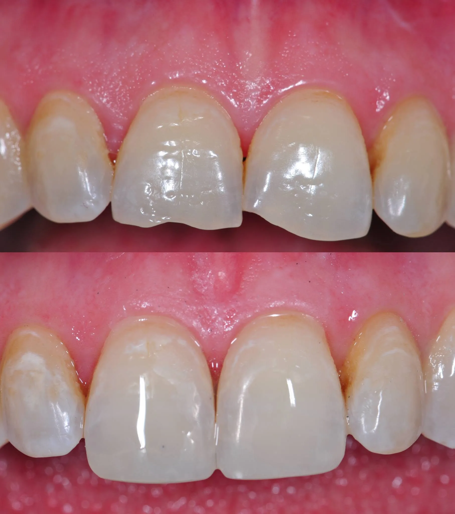 Before and after clinical photo: fractured front teeth restored