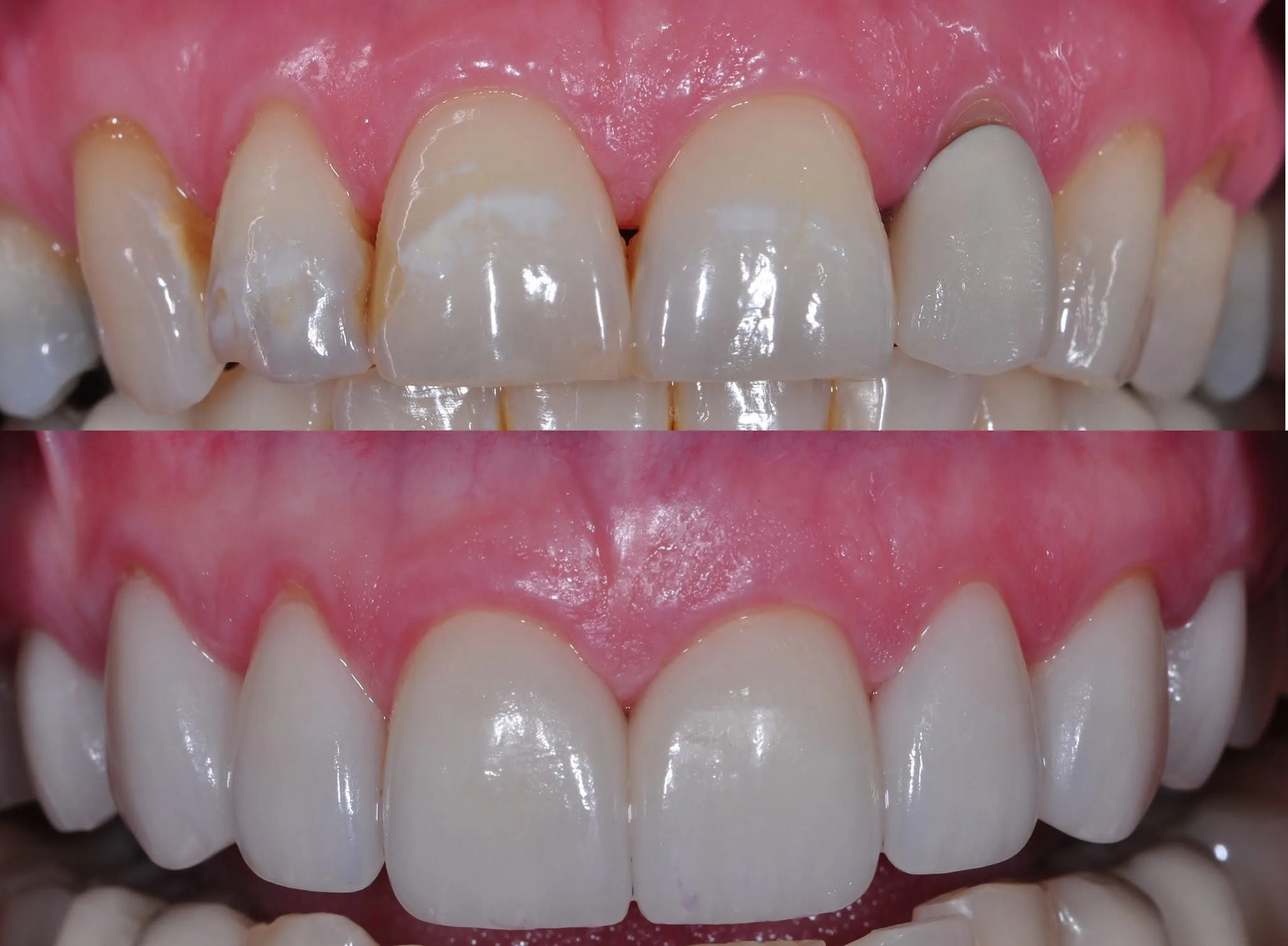 Before and after clinical photo: anterior veneers and crowns