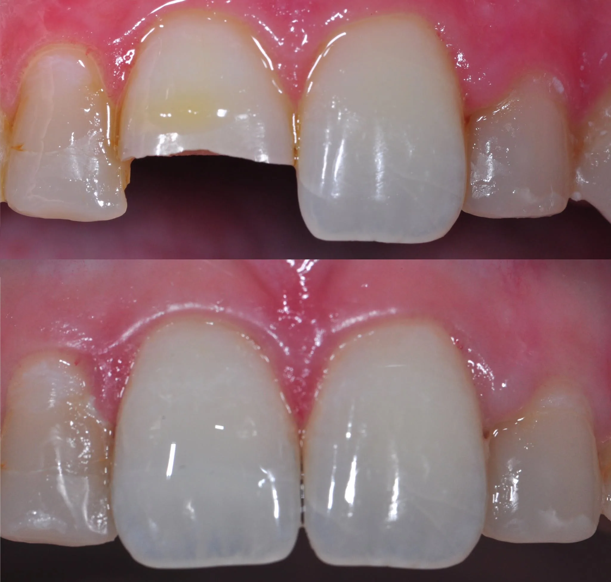 Before and after clinical photo: chipped central restored